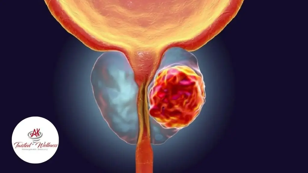 AK Twisted Wellness Guide Understanding Prostate Cancer Stages, Grades, and Treatment