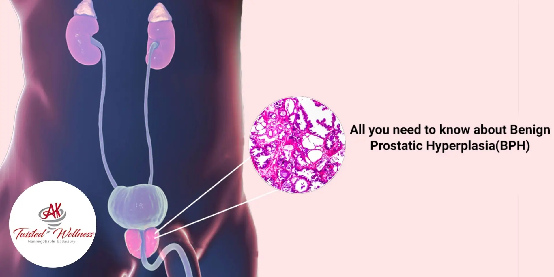 Benign Prostatic Hyperplasia