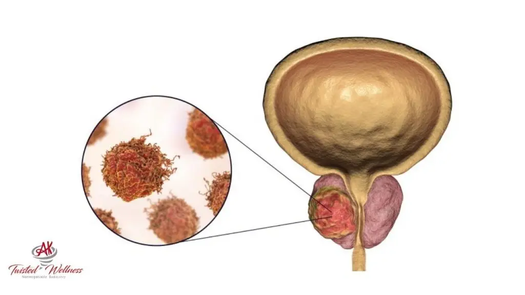Unlocking the Mystery of Prostate Cancer