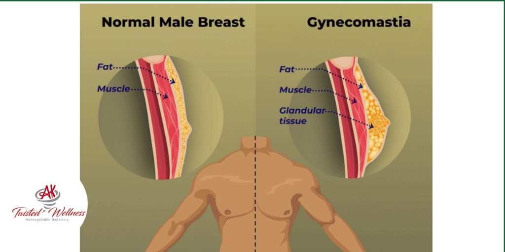 Gynecomastia