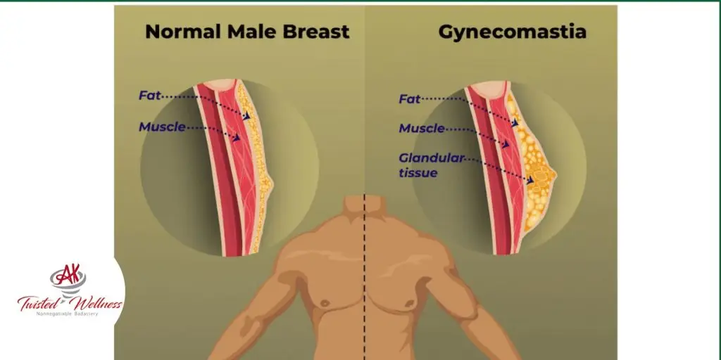 Gynecomastia