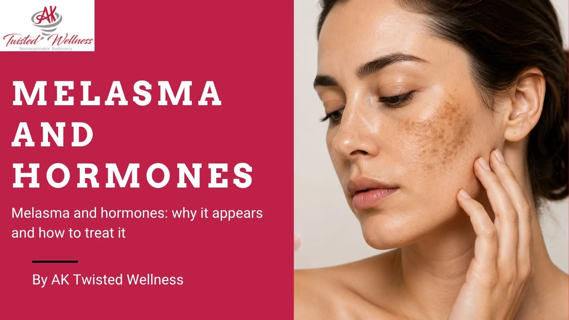 Melasma and hormones